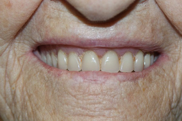 Denture Clinic Perth - Before and After Photos - Total Denture Care