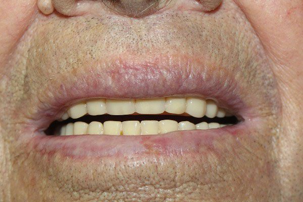 Best Denture Repair Perth - Before and After Photos - Total Denture Care