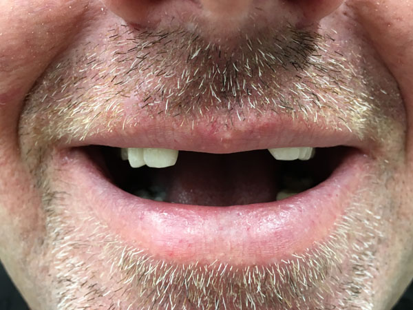 before-11 Emergency Denture Repair Perth - Before and After Photos - Total Denture Care