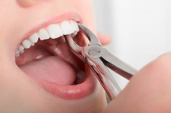 Tooth Extraction - Total Denture Care Perth